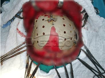 Cranium PEEK implant 02