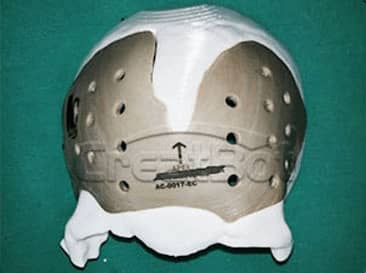 Cranium PEEK implant 03