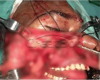 Humerus&Upper jawbone PEEK implant 04