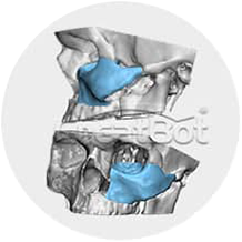 Os lacrimale&cheekbone PEEK implant 02