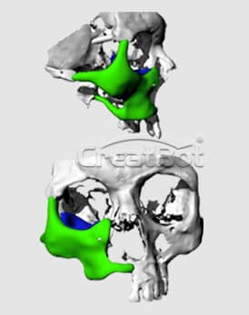 Os lacrimale&cheekbone PEEK implant 11