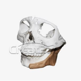 lower jawbone PEEK implant 01