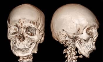 lower jawbone PEEK implant 02