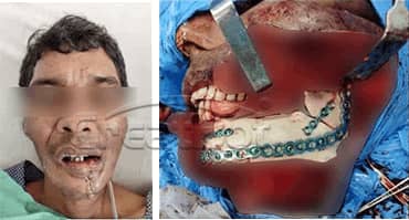 lower jawbone PEEK implant 08