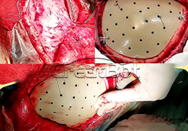 PEEK cranium implant07